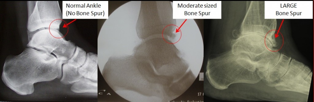 ankle bone spurs